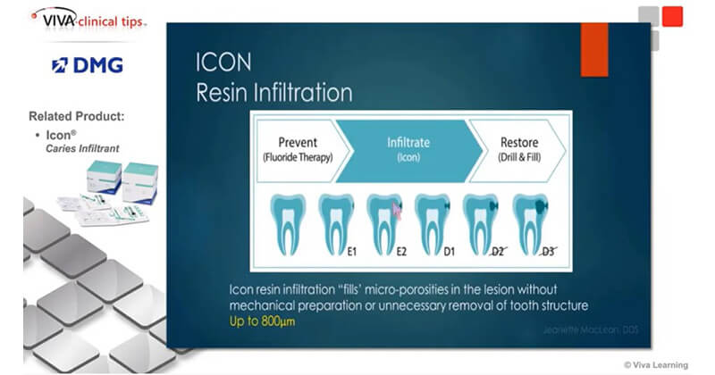 Dr. Jeanette MacLean discusses resin infiltration using Icon