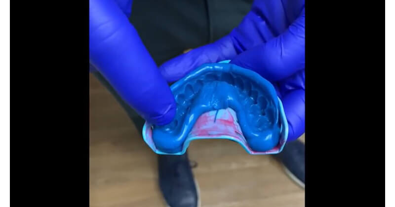 Fabricating A Putty Matrix for a Long Span Provisionalization of Esthetic Cases