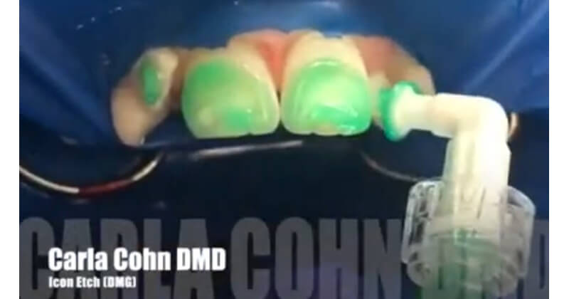 Smooth Surface Enamel Treatment Using Icon with Dr. Cohn