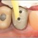 Restoration of an Endodontically Treated Maxillary First Premolar