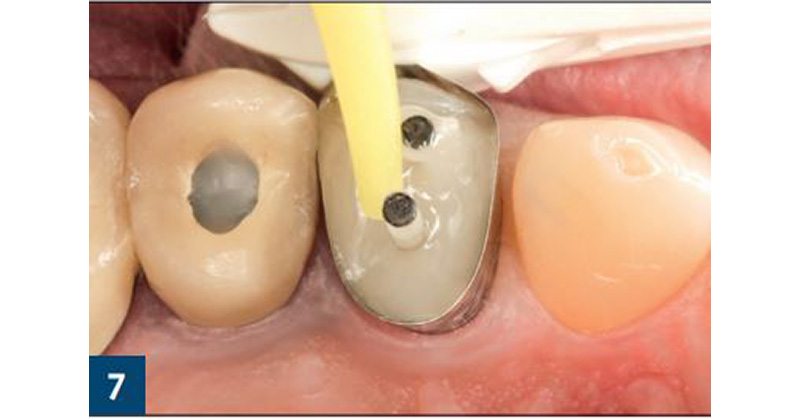 Restoration of an Endodontically Treated Maxillary First Premolar
