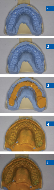 Impression Techniques for Clear Aligner or Occlusal Guards