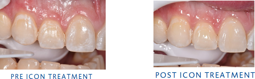 Post-Orthodontic White Spots Treatment with Icon