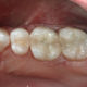 FIlling the gap in outcomes and productivity with posterior composite restorations