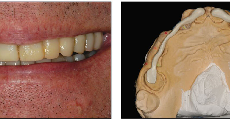 Fabricated Long-Term Provisional Restorations