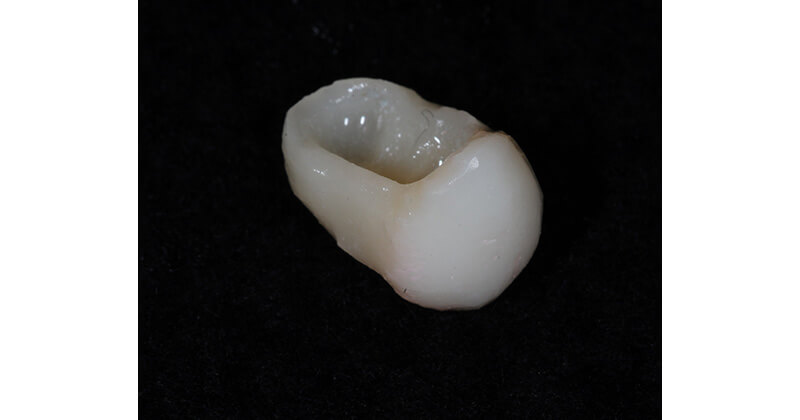 Long-term and Esthetically Pleasing Tooth Restoration