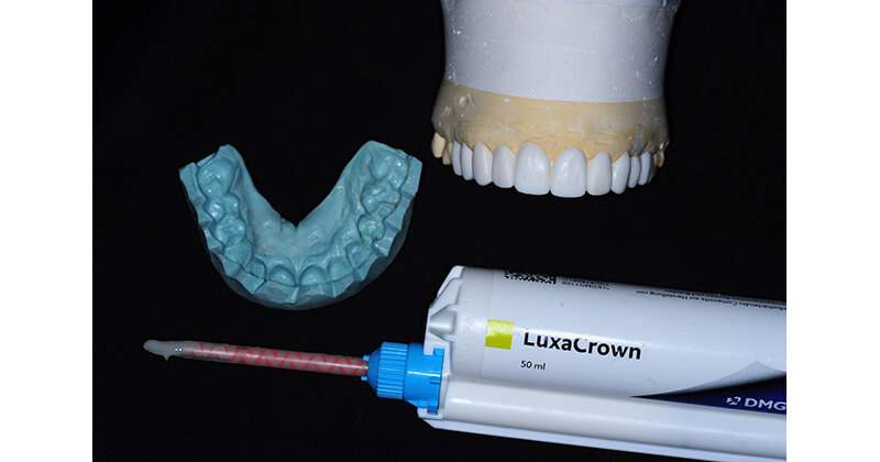 Long Term, Efficient and Esthetic Provisional Restorations
