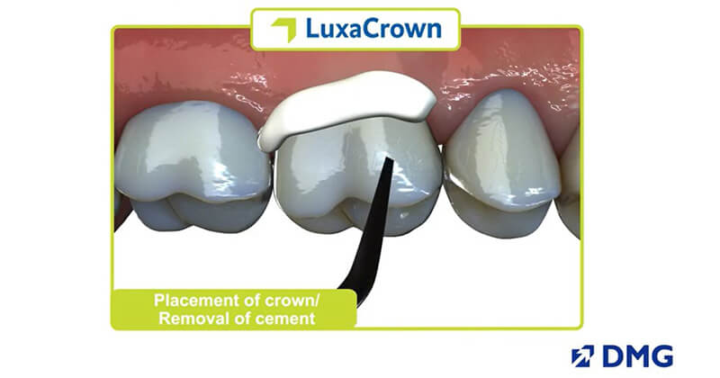 LuxaCrown: a perfect fit between temporary and permanent restorations