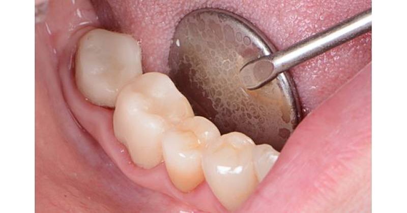 Semi-permanent solution for endodontically treated teeth