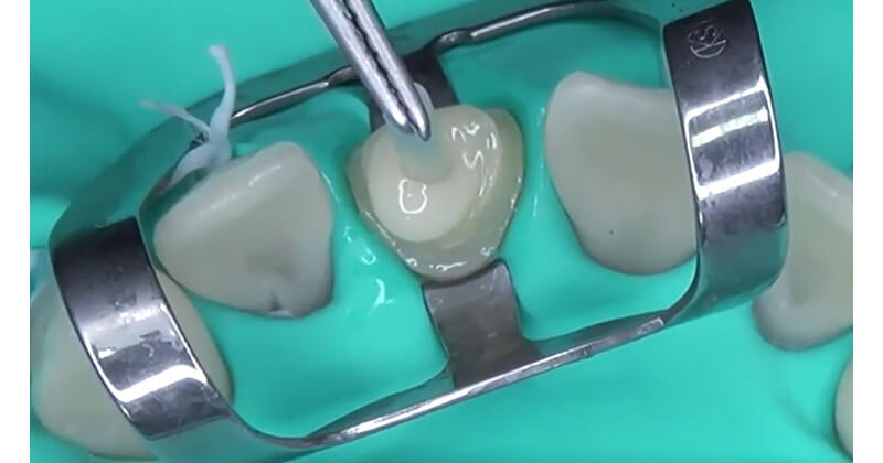 Post Cementation and Core Build Up Using LuxaCore Z Dual