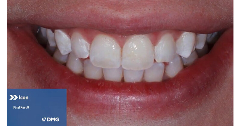 Using Icon Caries Infiltration to Treat Smooth Surface White Spots