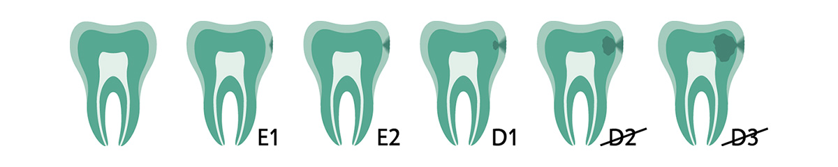 Graphic showing various lesion depth of a tooth