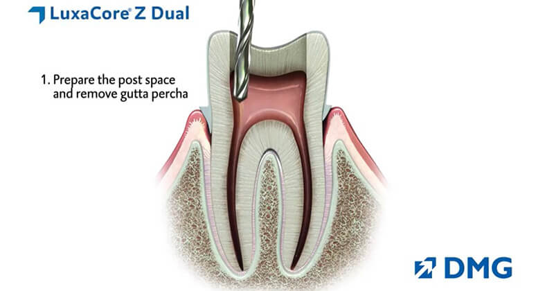 LuxaCore Z Dual: One Material for Core Builds AND Post Cementation
