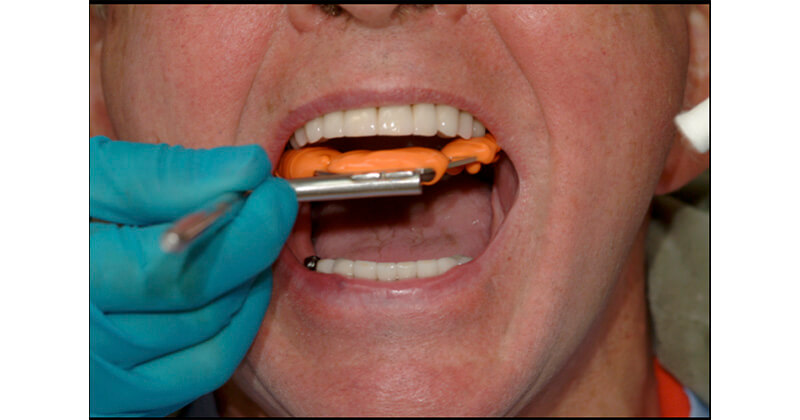 O-Bite Bite Registration. DMG - High quality dental materials for dentists  and dental technicians