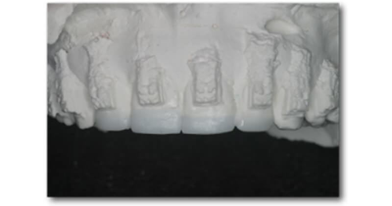 Splinted Incisal Edge Reconstruction with Semi-Permanent Crown Shells