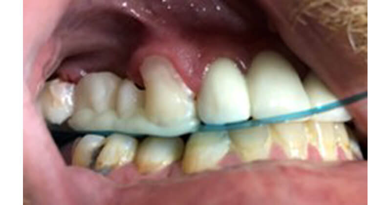 Correcting Poor Occlusion Using LuxaCrown and Ecosite Bulk Fill