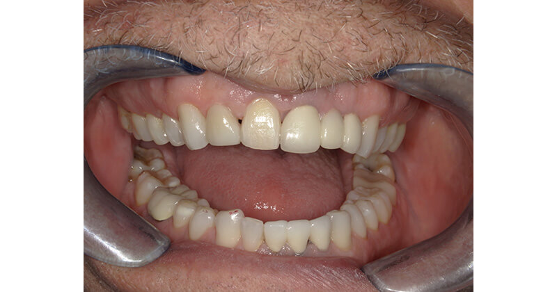 Replacing a Missing Tooth: Bonding a Pontic to a Braided Orthodontic Wire
