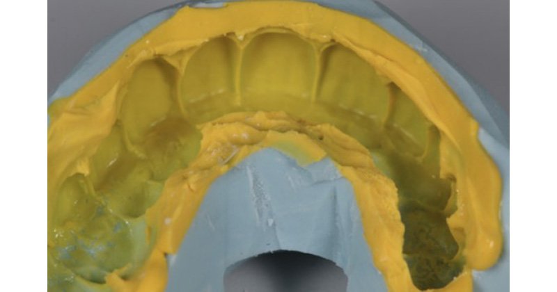 analog technique in implant-supported temporary restorations