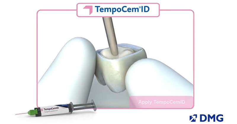 A Quick Guide to Cementation with TempoCemID