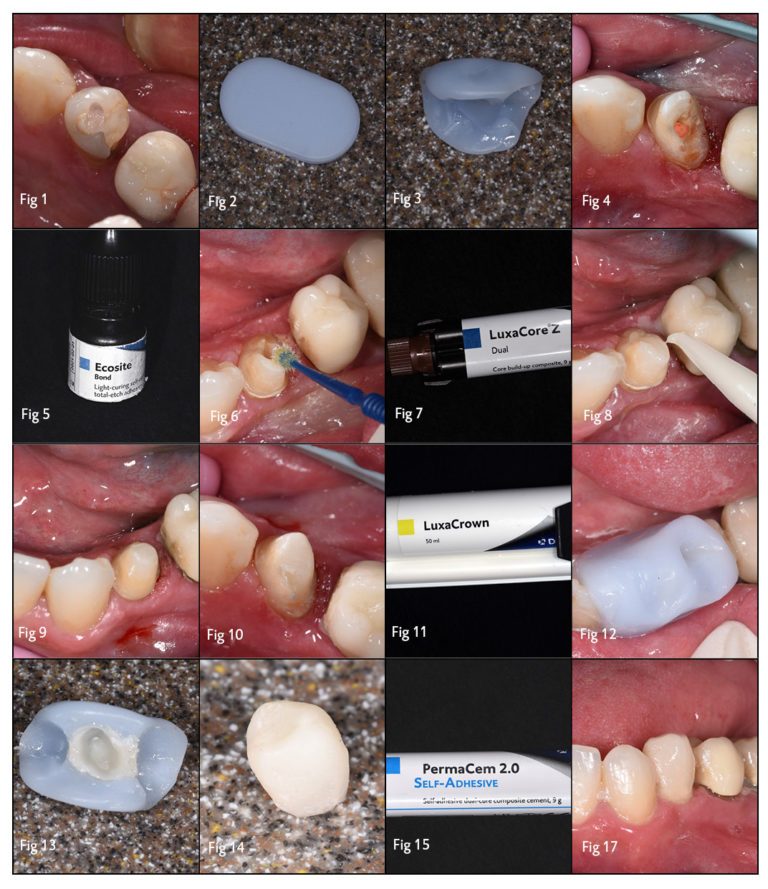 Technique for Creating Core Buildups and Provisional Crowns DMG America