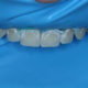 Post Orthodontic White Spot Lesions Treatment with Icon Caries Infiltrant
