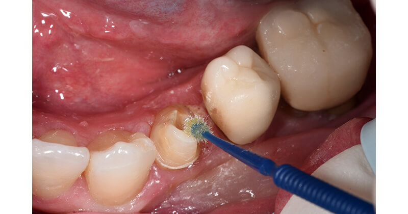 Creating Core Build-ups and Provisional Crowns