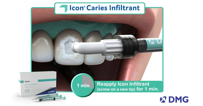 Icon Smooth Surface Caries Infiltrant, Quick Guide