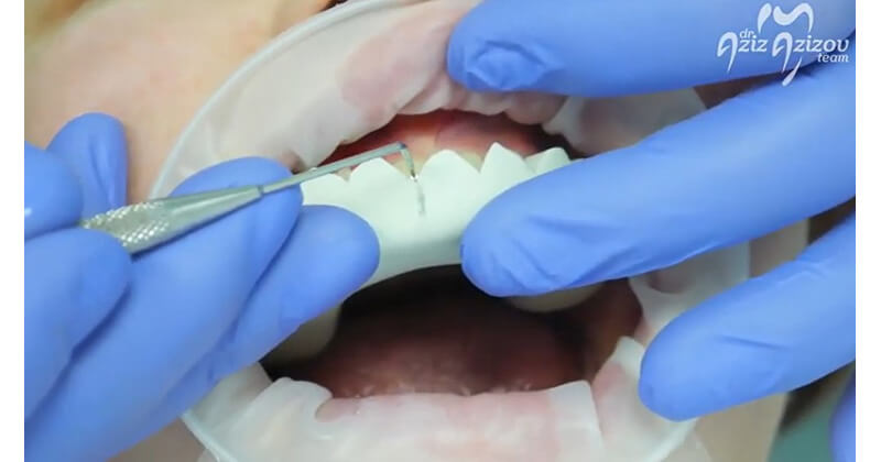 the amazing transformation with LuxaCrown semi-permanent crown and bridge material