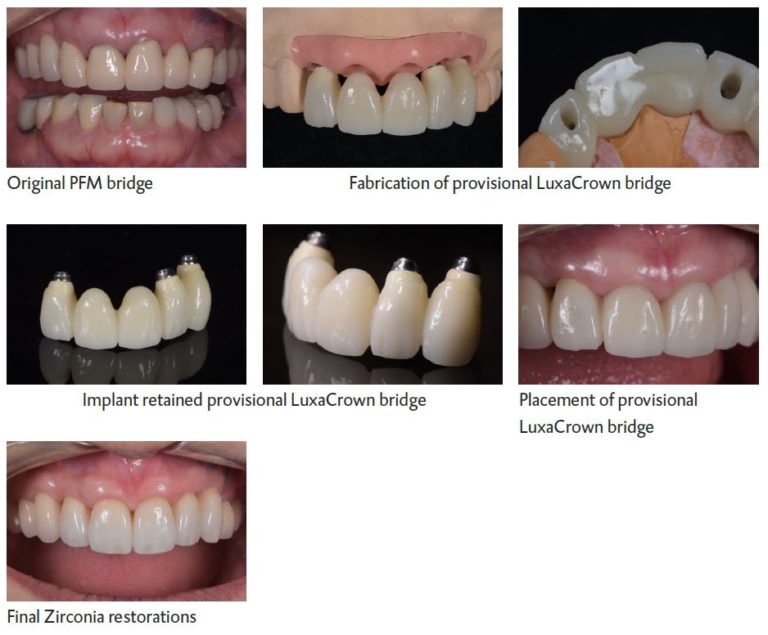 Fabricating A Stain And Fracture-resistant Provisional Bridge With 