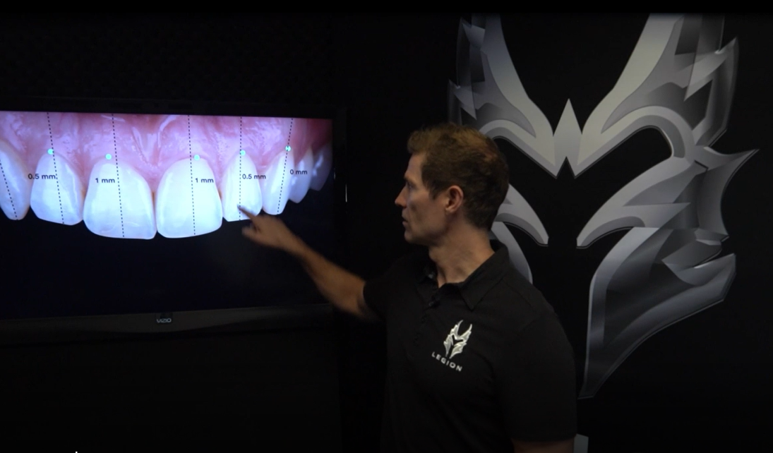 Smile Design With Dr Todd Snyder Part 6 Dmg America