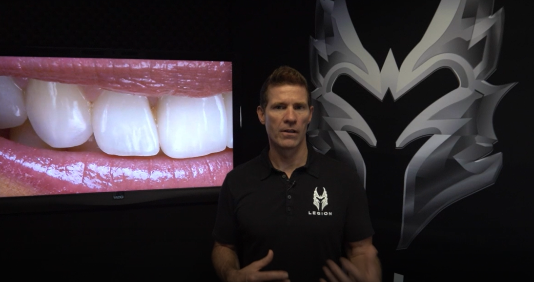 Smile Design With Dr Todd Snyder Part 7 Dmg America